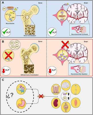 Systemic effects of hypophosphatasia characterization of two novel variants in the ALPL gene